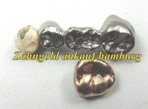 Zahngold Hamburg Zahngold ankauf